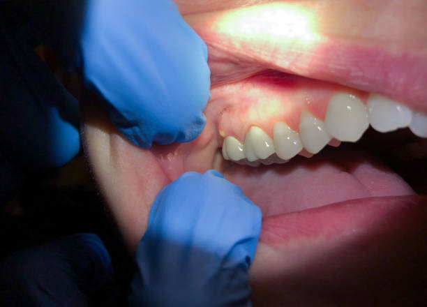 Best Emergency Denture Repair in South Highpoint, FL